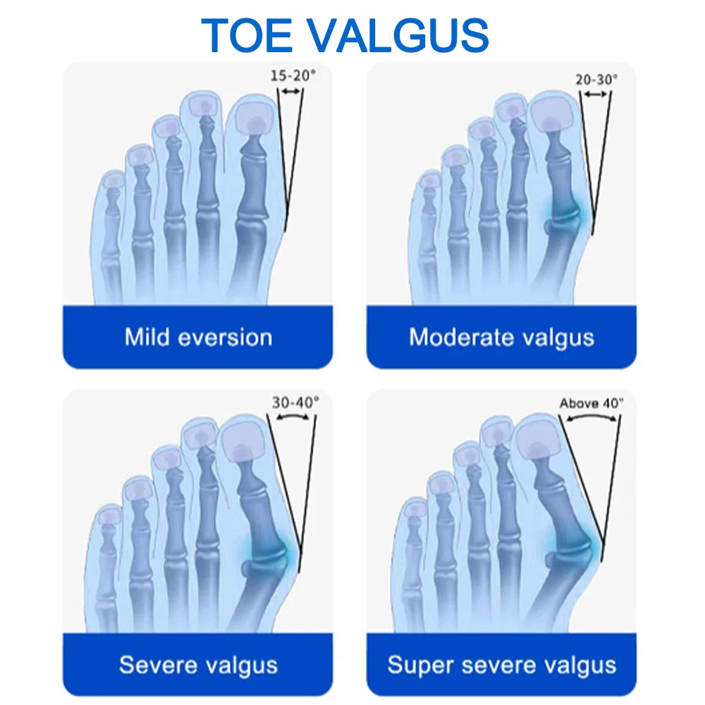 Bunion Splint Big Toe Straightener Hallux Valgus Correction Orthotics Foot Bone Thumb Adjuster Correction Pedicure Brace
