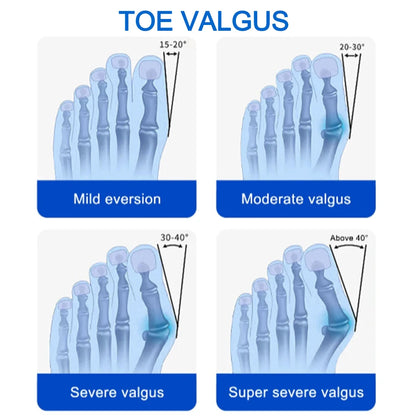 Bunion Splint Big Toe Straightener Hallux Valgus Correction Orthotics Foot Bone Thumb Adjuster Correction Pedicure Brace